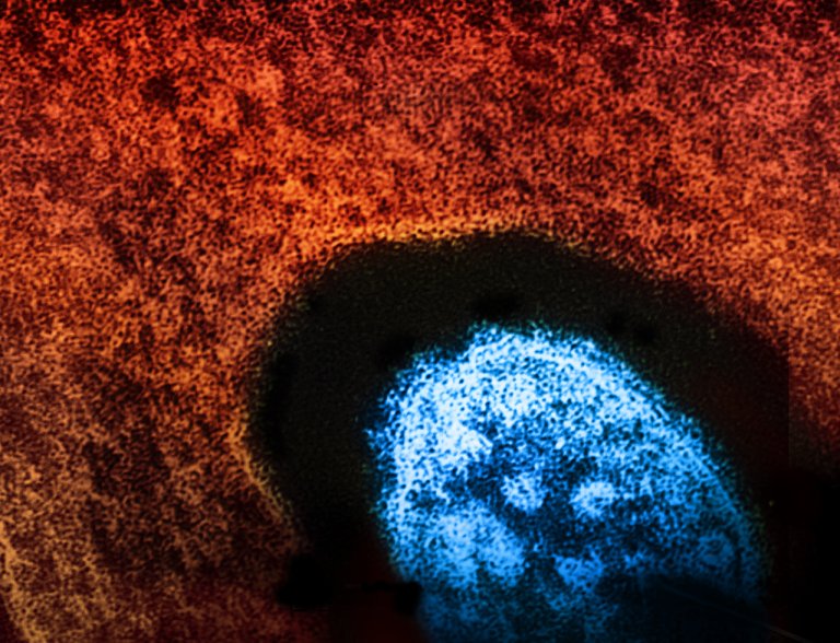 Colorado reports measles case in Pueblo, not tied to ongoing Texas outbreak